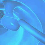 Polipectomia